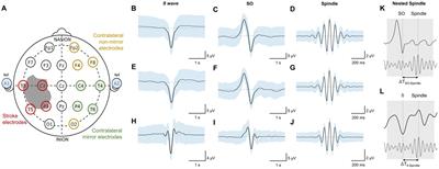 Disturbed laterality of non-rapid eye movement sleep oscillations in post-stroke human sleep: a pilot study